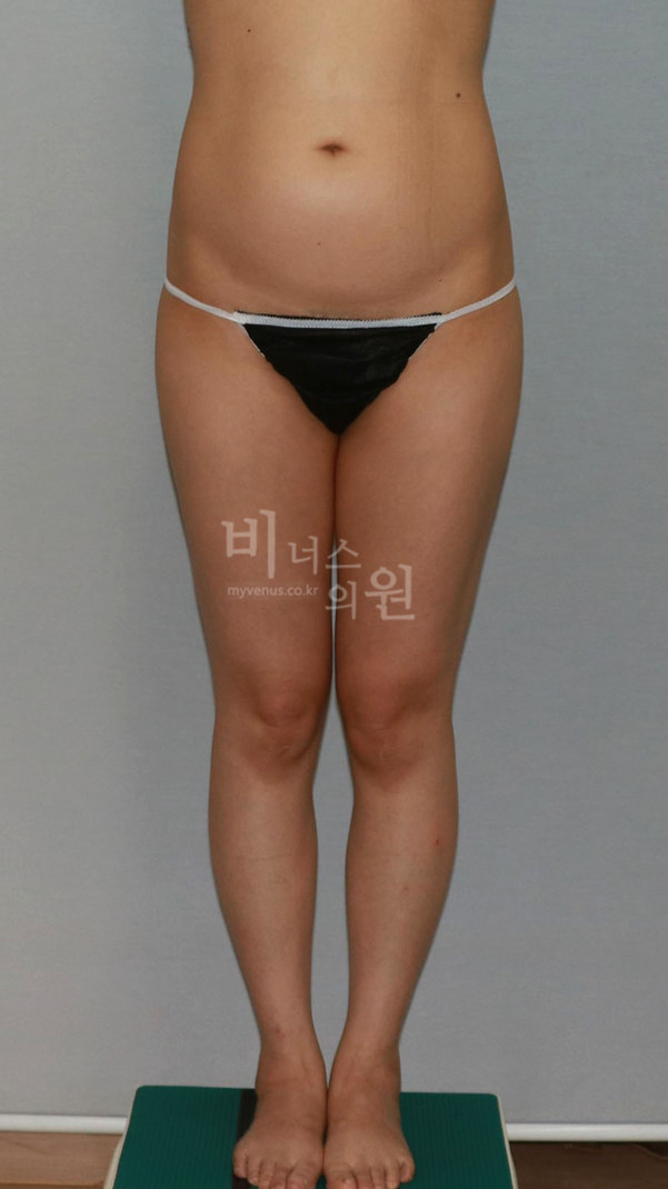 엉덩이축소 지방흡입 수술 후 정면