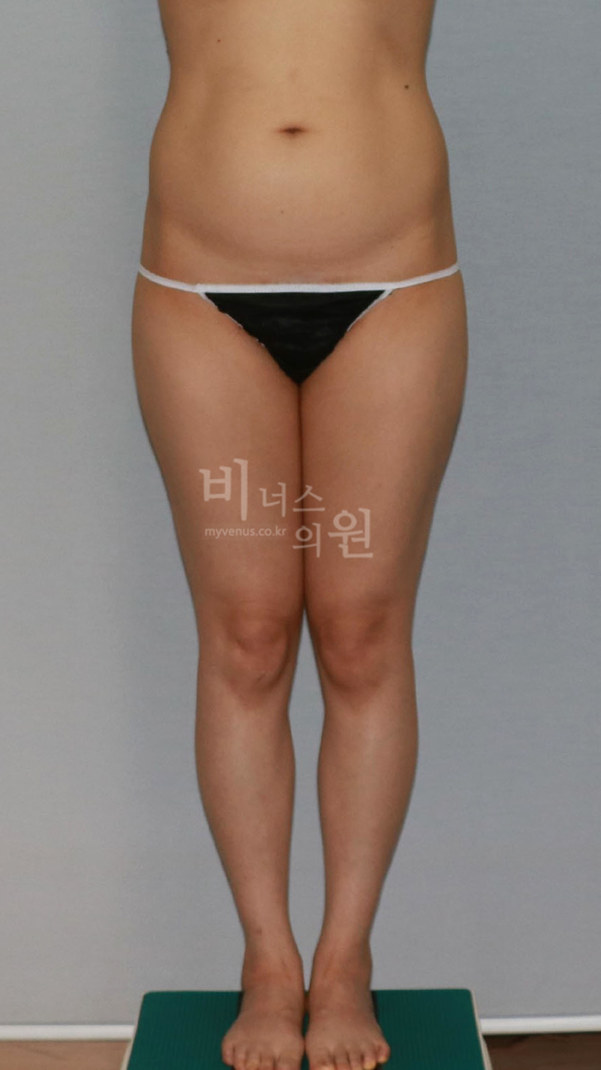 엉덩이축소 지방흡입 수술 전 정면