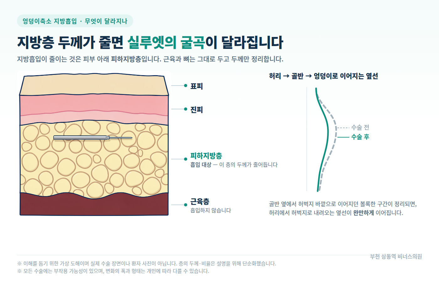 피하지방층 단면 의학 도해 — 지방층 두께가 줄면 허리 골반 엉덩이 옆선이 완만해지는 변화