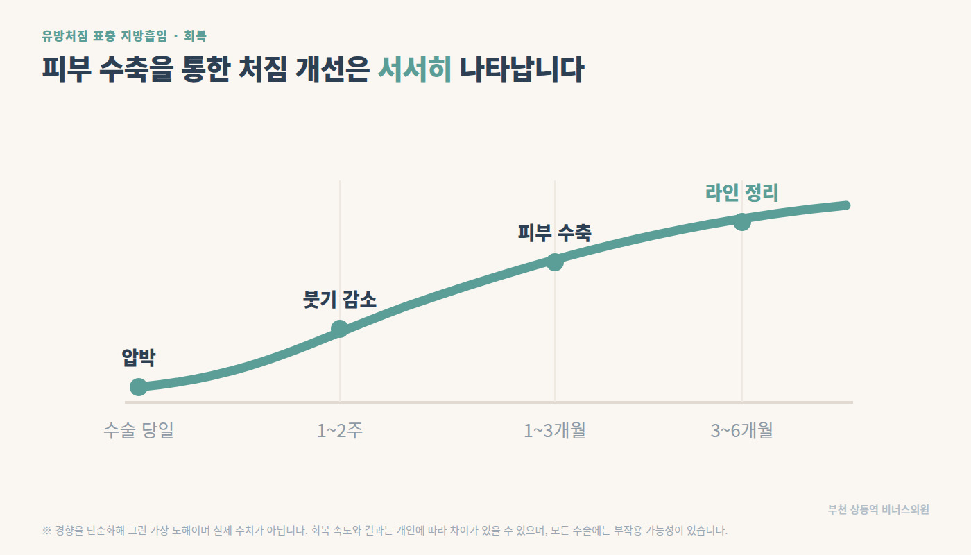 유방처짐 지방흡입 회복 인포그래픽 — 수술 당일부터 3~6개월까지 피부 수축을 통한 처짐 개선 흐름