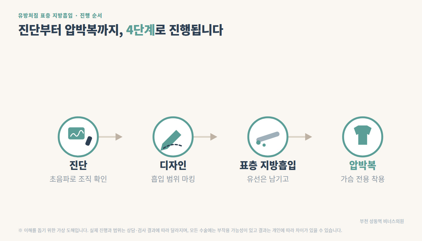 유방처짐 표층 지방흡입 4단계 인포그래픽 — 진단, 디자인, 표층 지방흡입, 가슴 전용 압박복