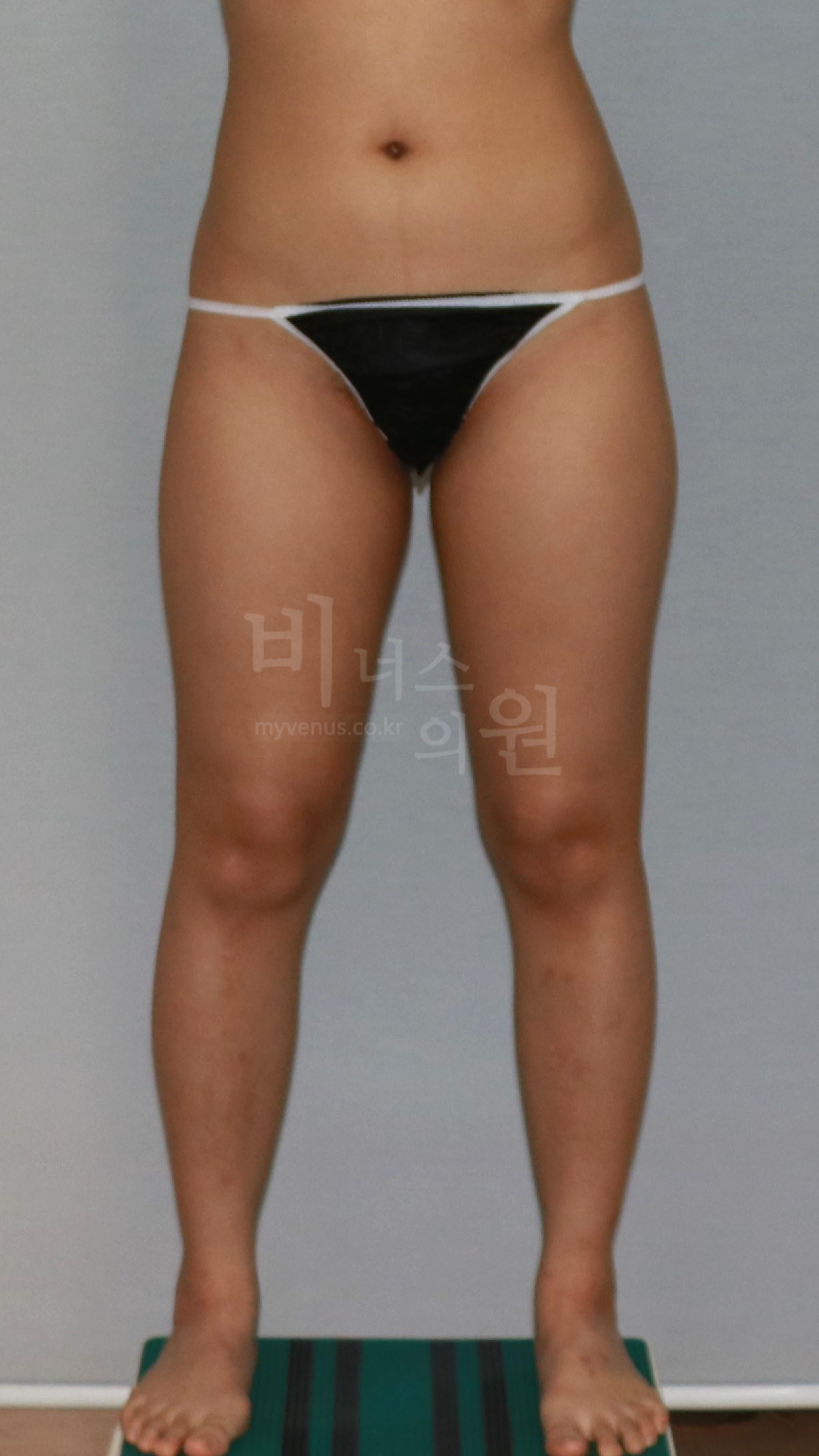 허벅지 지방흡입 수술 전 정면