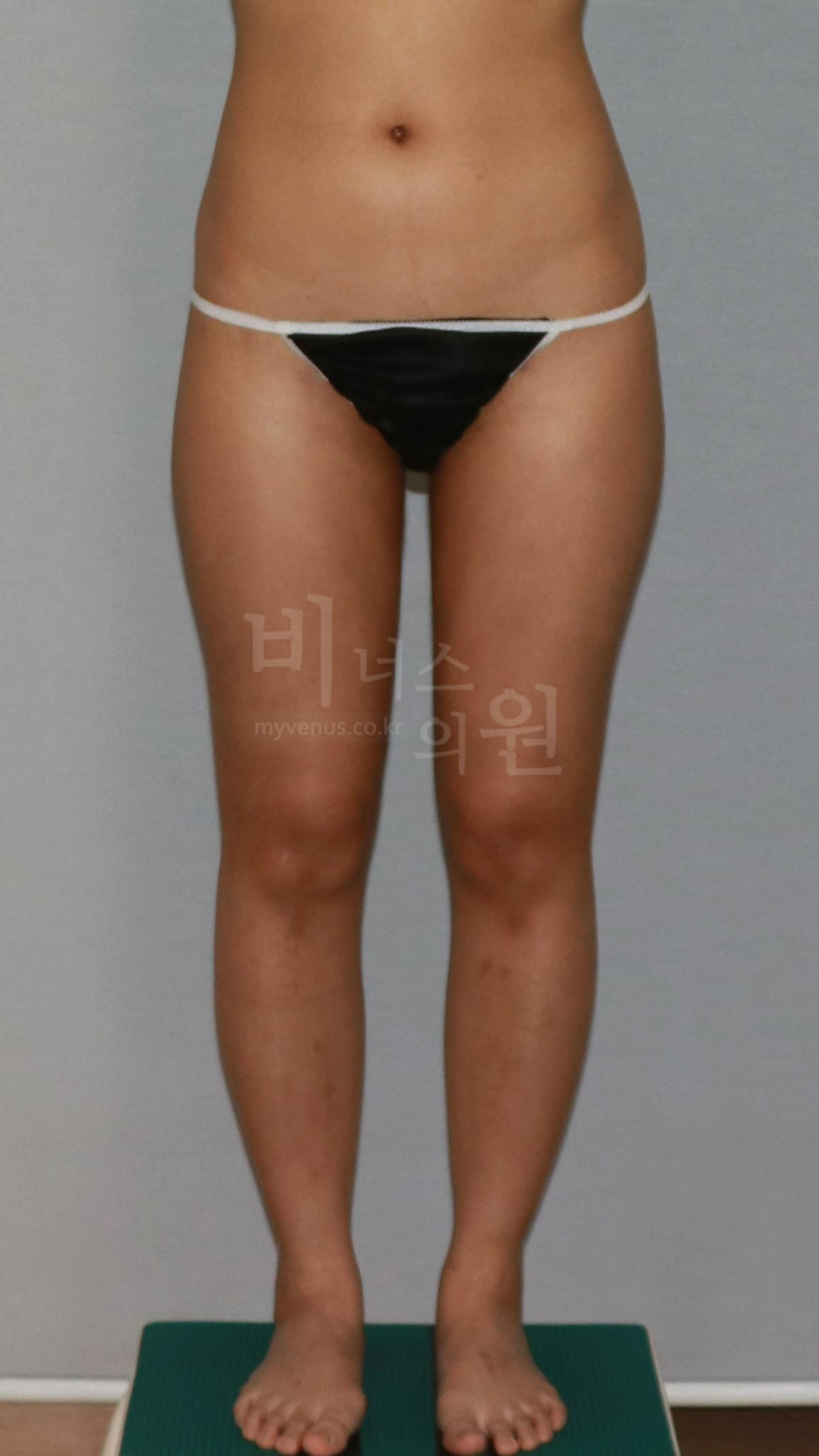 허벅지 지방흡입 수술 후 정면