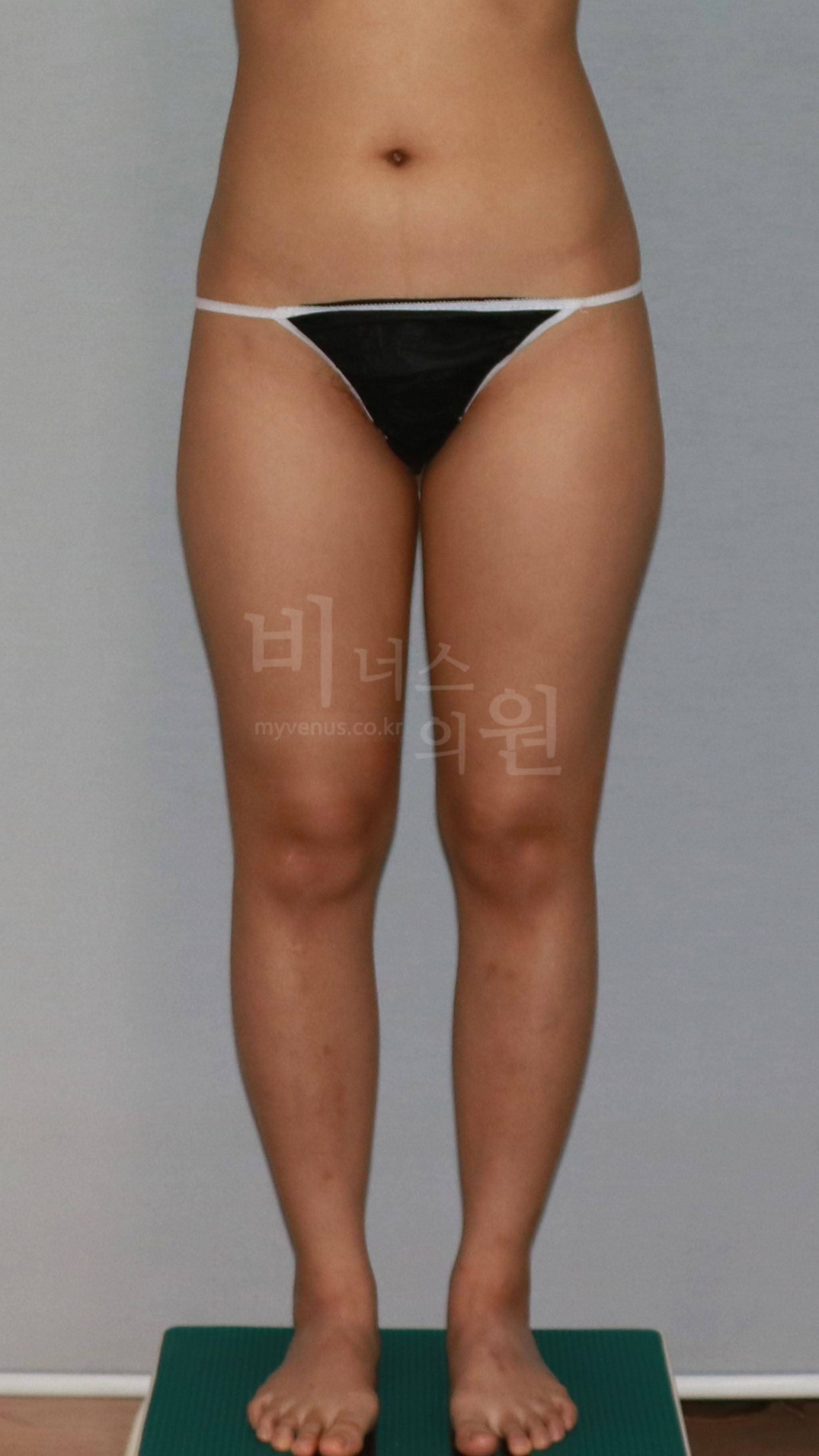 허벅지 지방흡입 수술 전 정면