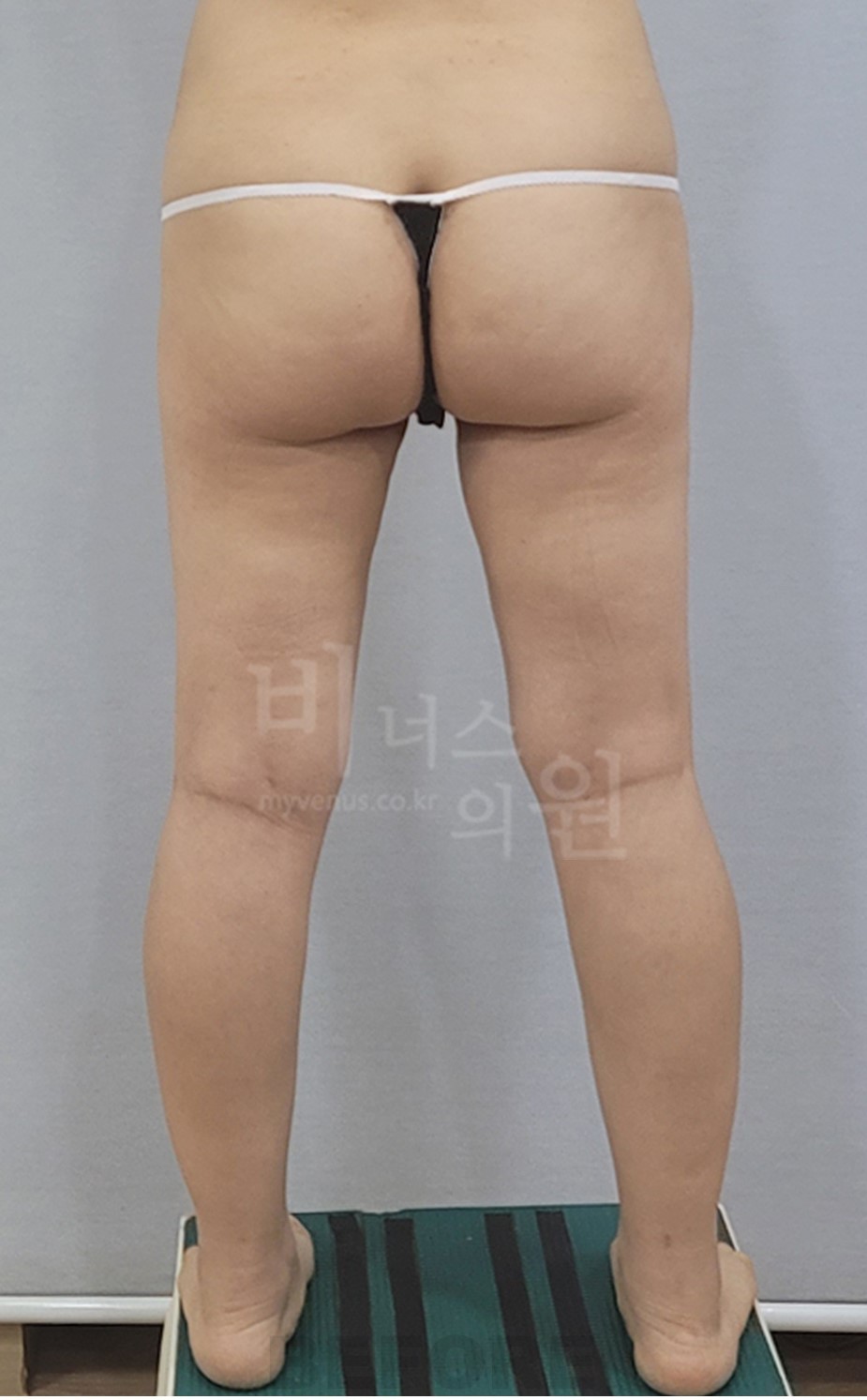엉덩이축소 지방흡입 수술 전 후면