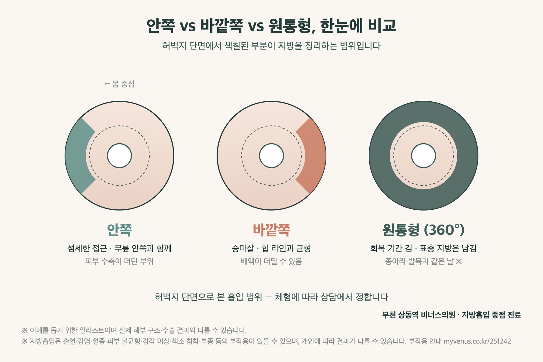 허벅지 단면으로 본 안쪽·바깥쪽·원통형 지방흡입 범위 비교 인포그래픽
