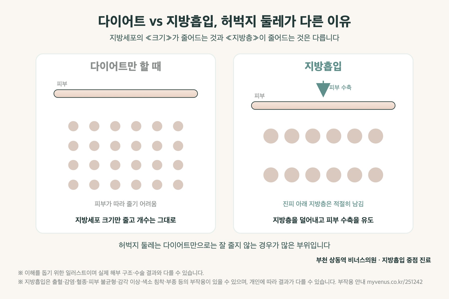 다이어트와 지방흡입의 차이 — 지방세포 크기 감소와 지방층 제거 비교 인포그래픽