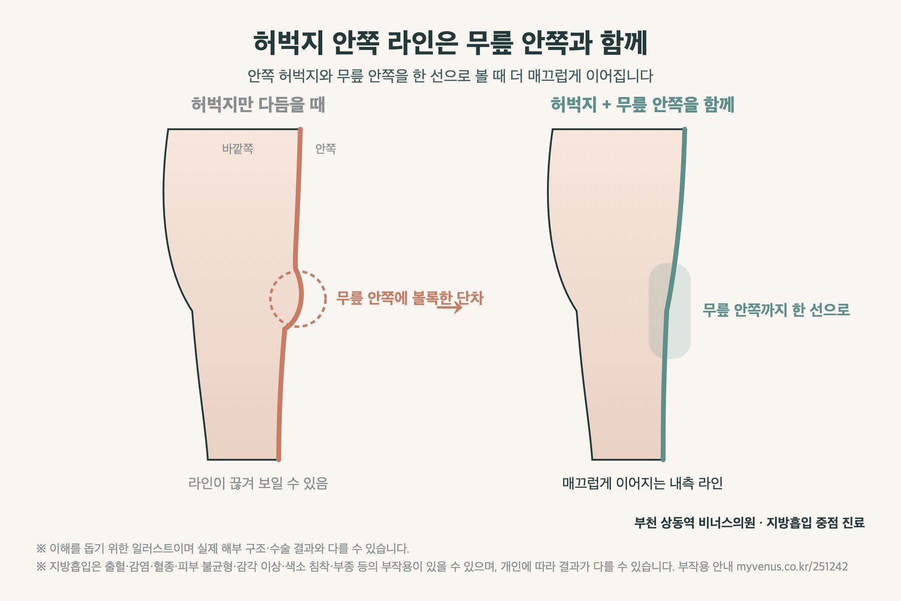 허벅지 안쪽 라인을 무릎 안쪽과 함께 다듬을 때 매끄럽게 이어지는 도해