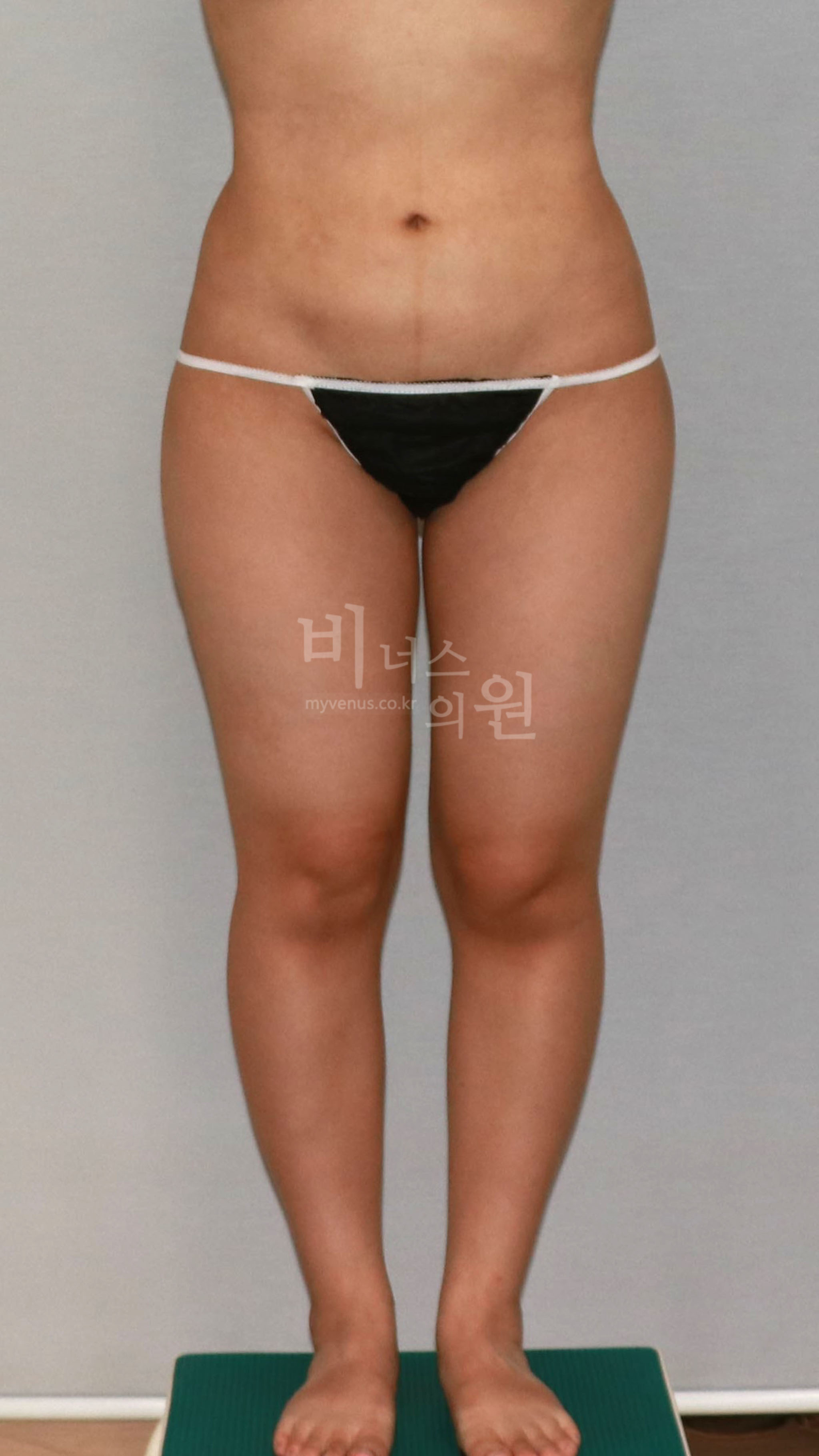 허벅지 지방흡입 수술 전 정면