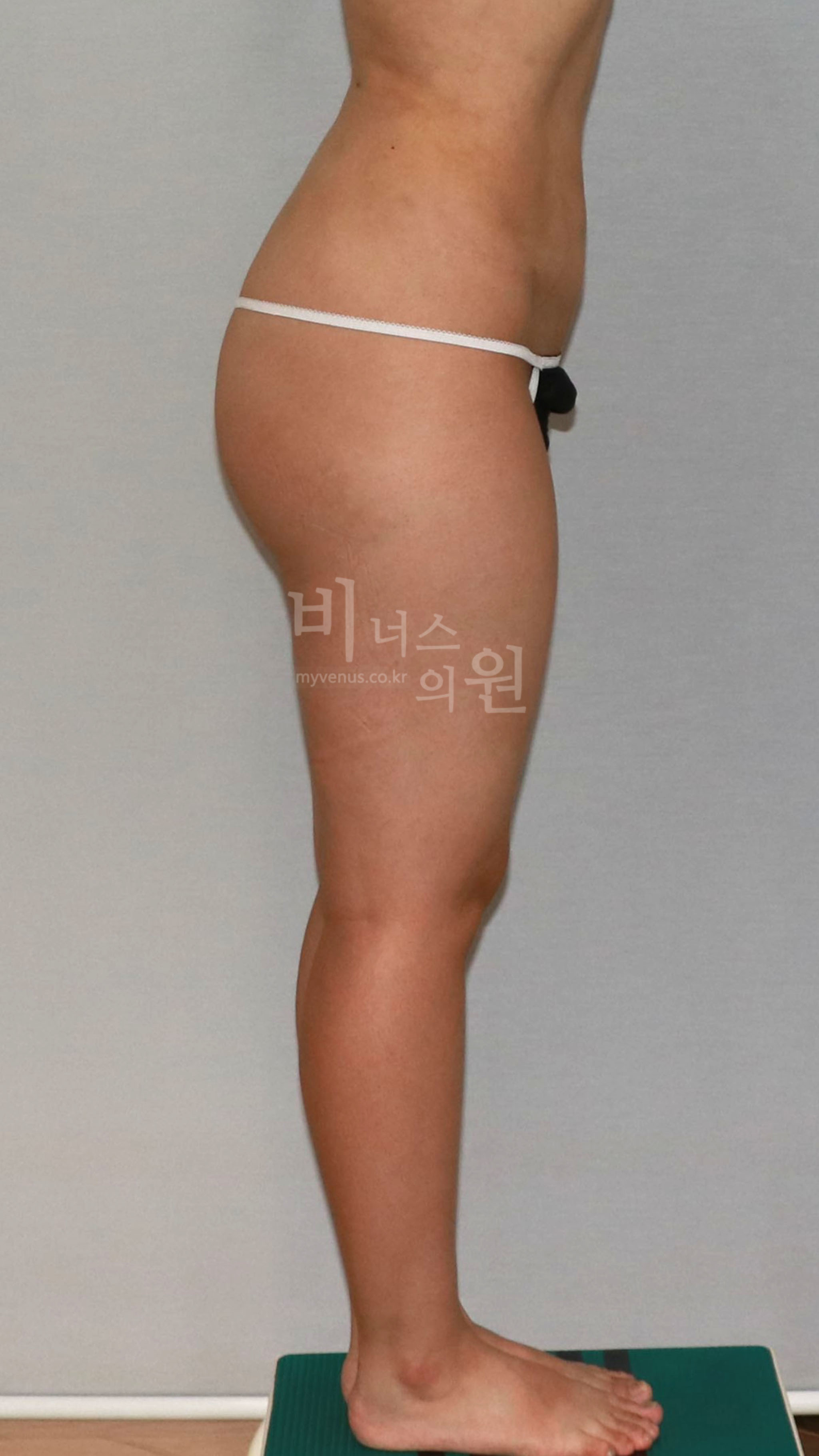 허벅지 지방흡입 수술 전 측면