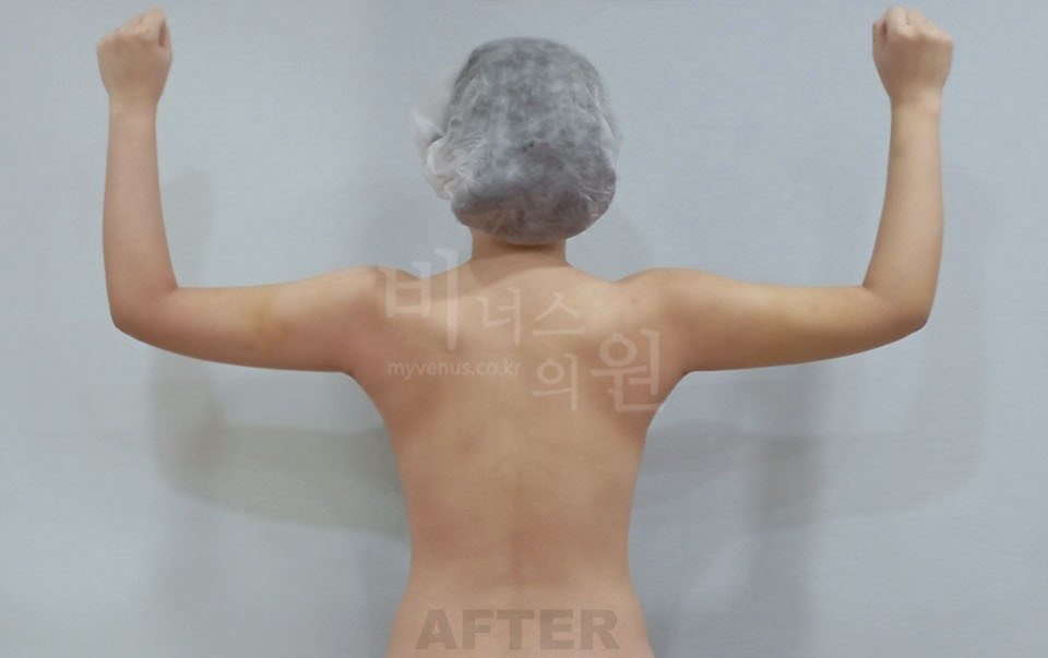 팔뚝지방흡입 후면(팔 굽혀 든 자세) 수술 후