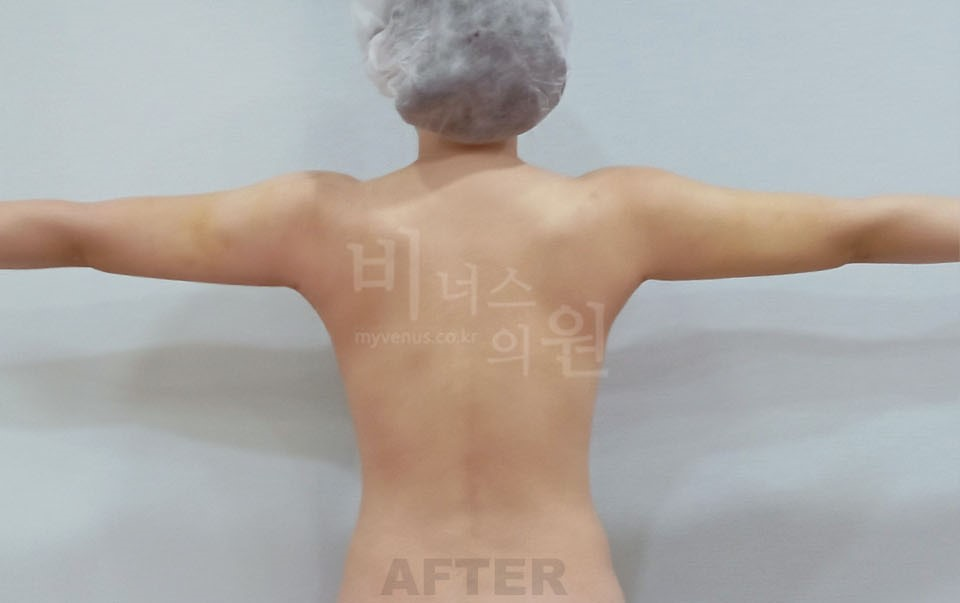 팔뚝지방흡입 후면(팔 벌린 자세) 수술 후