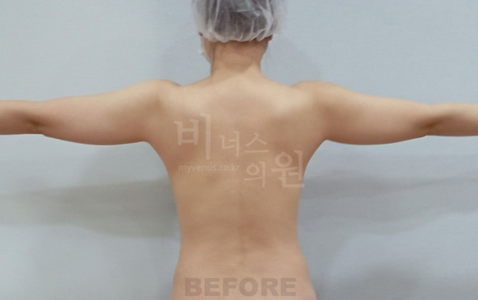 팔뚝지방흡입 후면(팔 벌린 자세) 수술 전