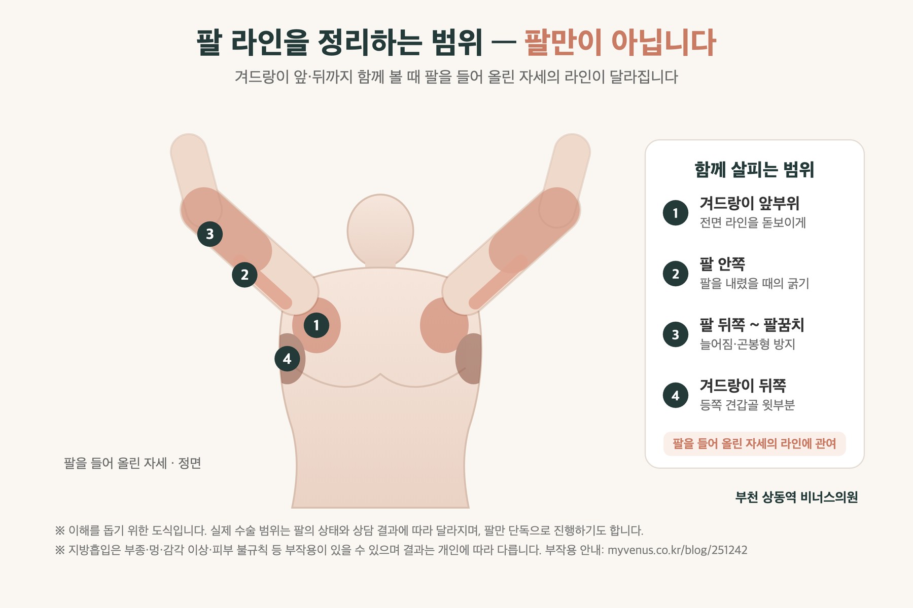 팔 지방흡입 범위 인포그래픽 — 겨드랑이 앞부위·팔 안쪽·팔 뒤쪽~팔꿈치·겨드랑이 뒤쪽 네 부위 도식