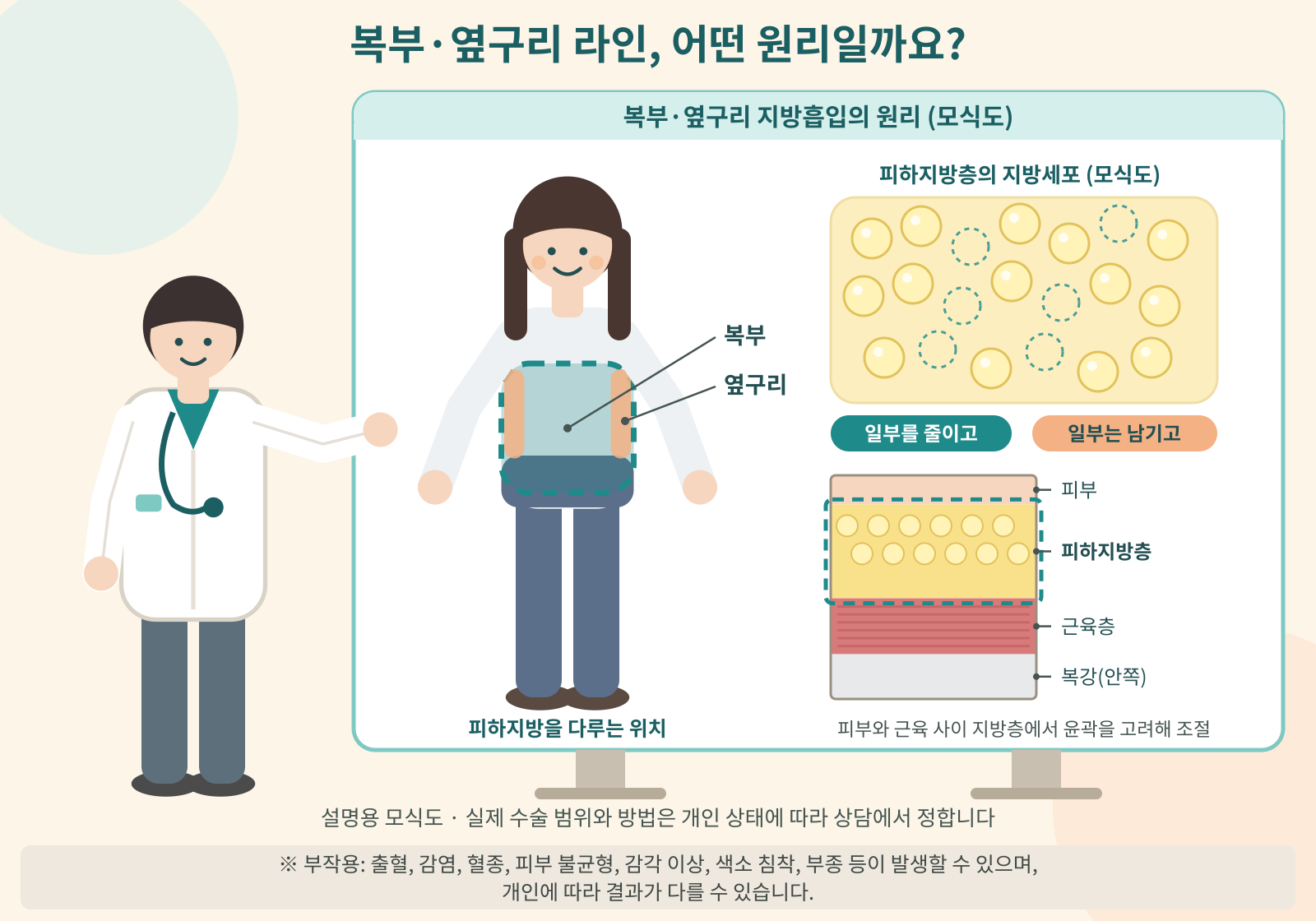 복부·옆구리 지방흡입 원리 모식도: 의료진이 가리키는 교육 보드에 옷 입은 여성의 복부와 몸통 좌우 허리 가장자리(옆구리) 위치 표시, 피하지방층 지방세포 모식도(일부를 줄이고 일부는 남김), 조직 블록 단면