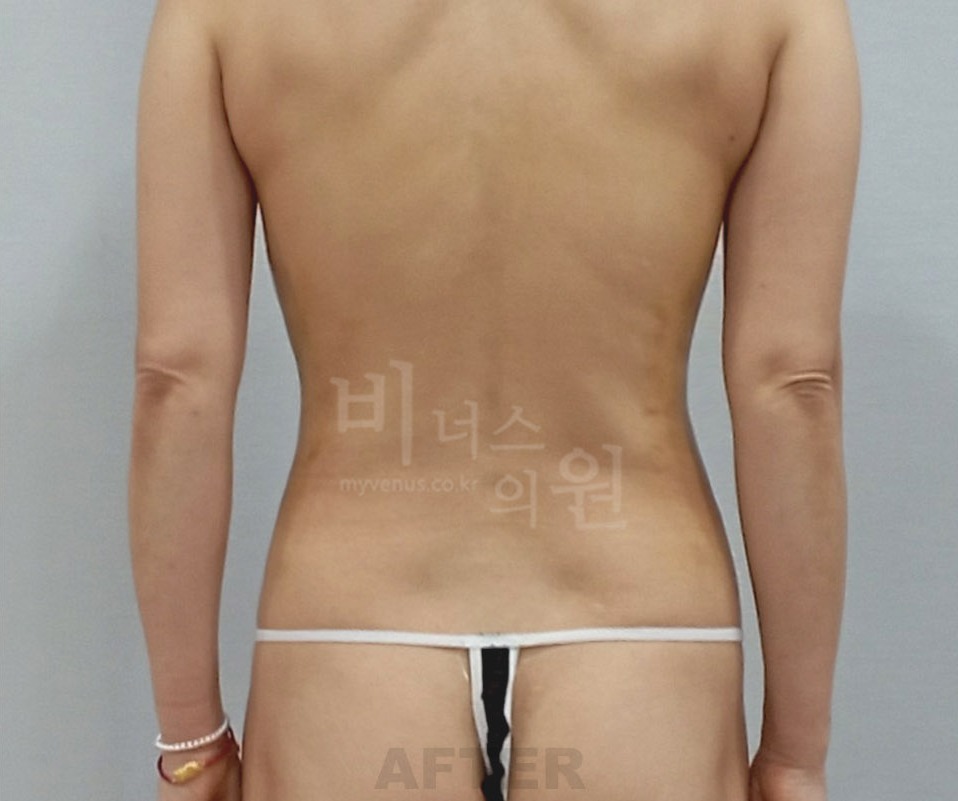 복부 지방흡입 수술 후 후면 ①