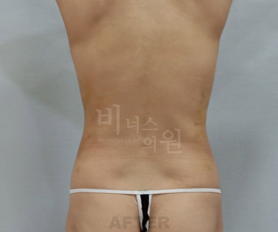 복부 지방흡입 수술 후 후면 ②