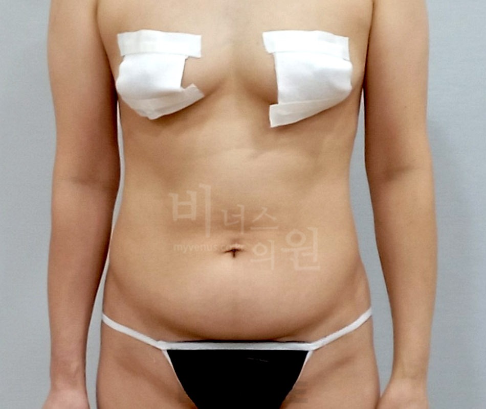 복부 지방흡입 수술 전 정면 ①