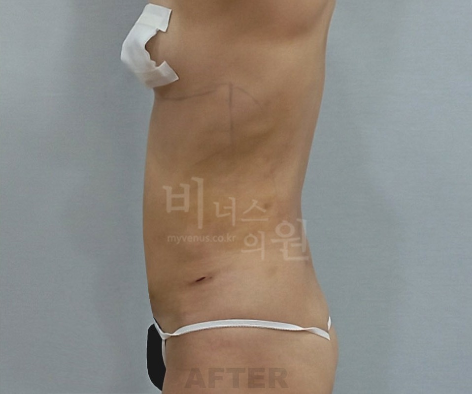 복부 지방흡입 수술 후 측면