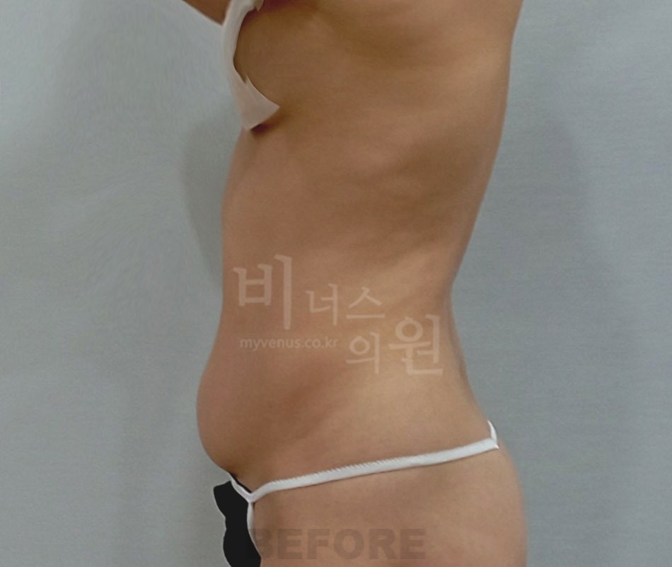 복부 지방흡입 수술 전 측면