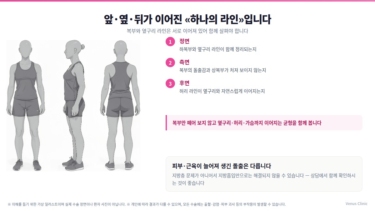 복부지방흡입 정면·측면·후면 확인 포인트 인포그래픽 — 복부와 옆구리 라인은 이어져 있어 함께 살핀다