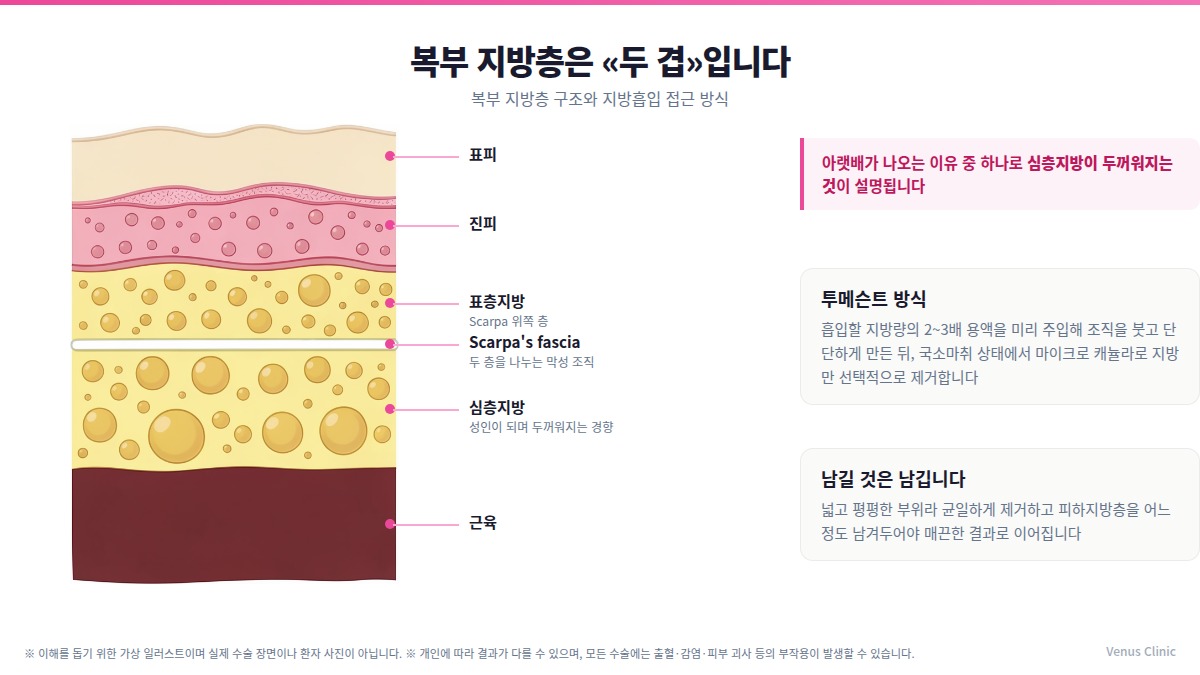 복부 지방층 구조 인포그래픽 — 표피·진피·표층지방·Scarpa's fascia·심층지방·근육 단면과 투메슨트 방식