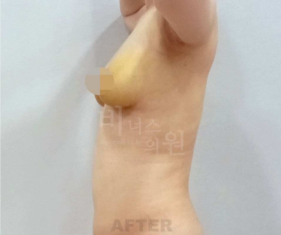 유방하수 가슴축소 지방흡입 수술 후 측면