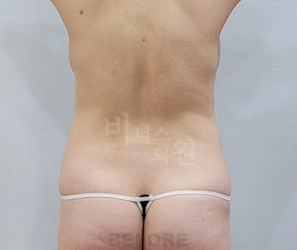 복부지방흡입 수술 전 후면 사진