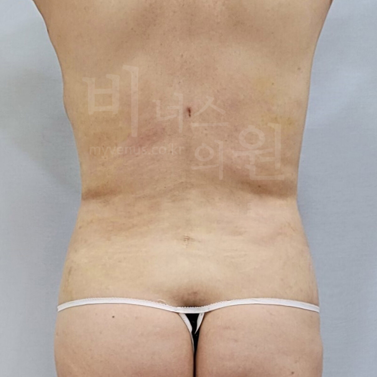 흉복부 지방흡입 수술 후 후면 사진