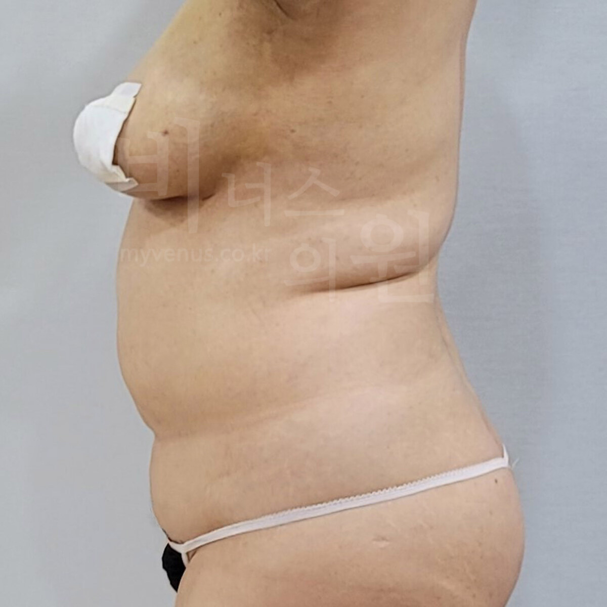 뱃살지방흡입 수술 전 측면 사진