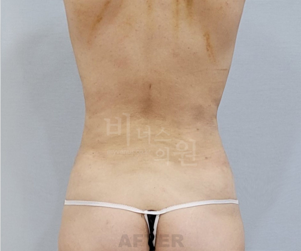 복부 지방흡입 수술 후 후면