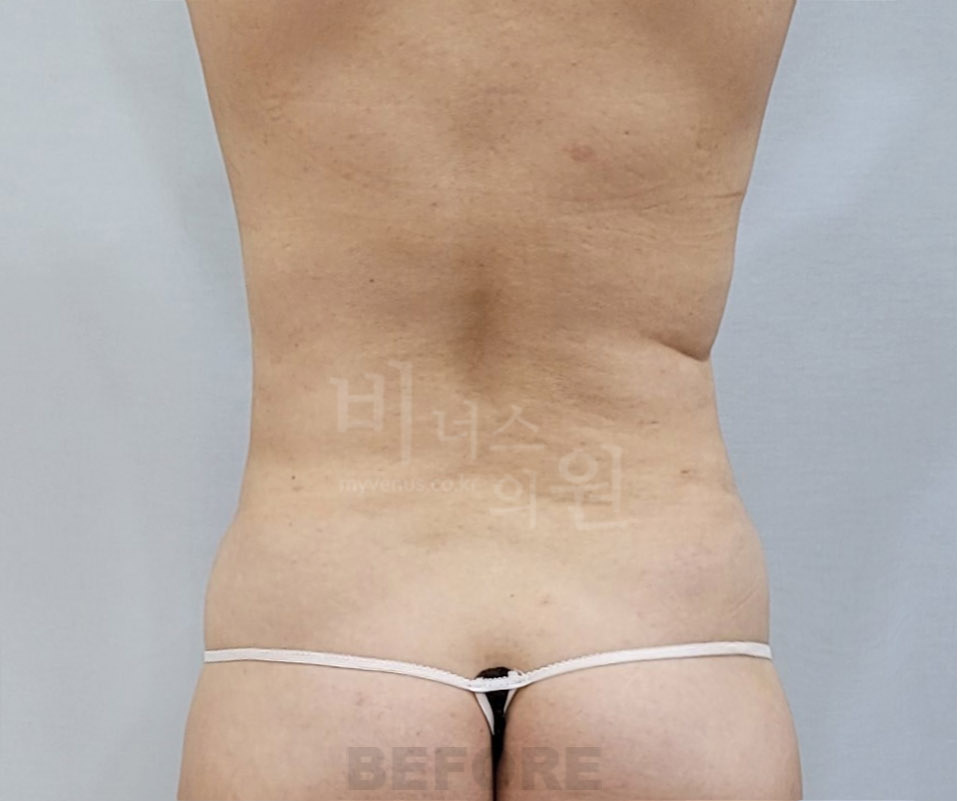 복부 지방흡입 수술 전 후면