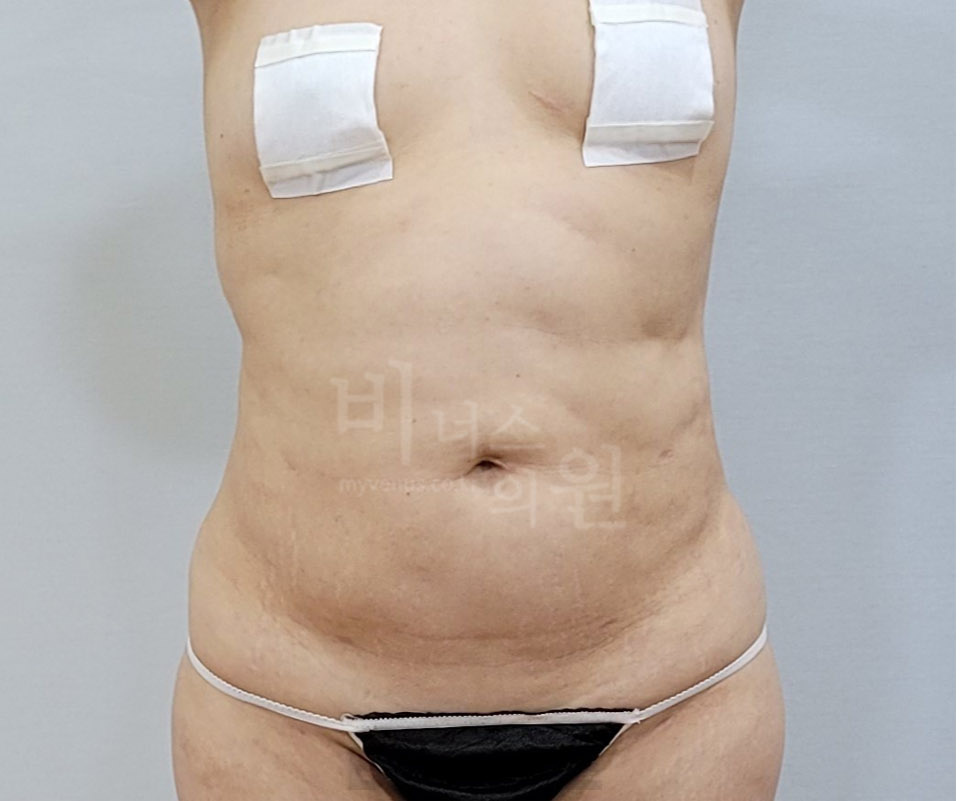 복부 지방흡입 수술 전 정면