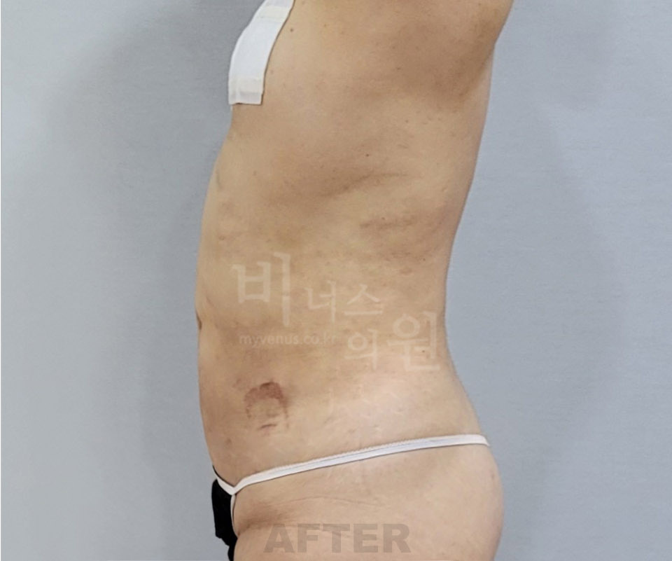 복부 지방흡입 수술 후 측면