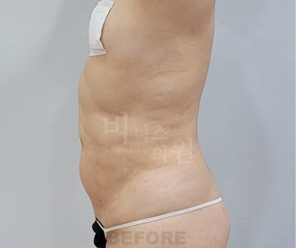 복부 지방흡입 수술 전 측면
