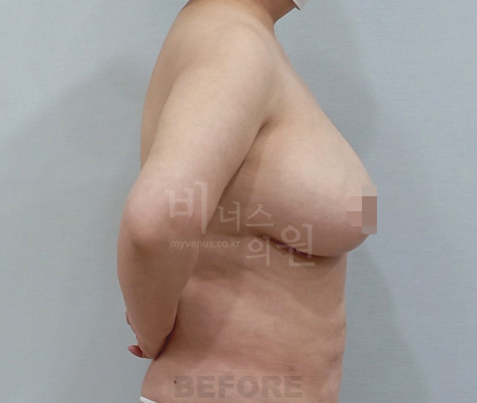 유방 부위 측면 수술 전