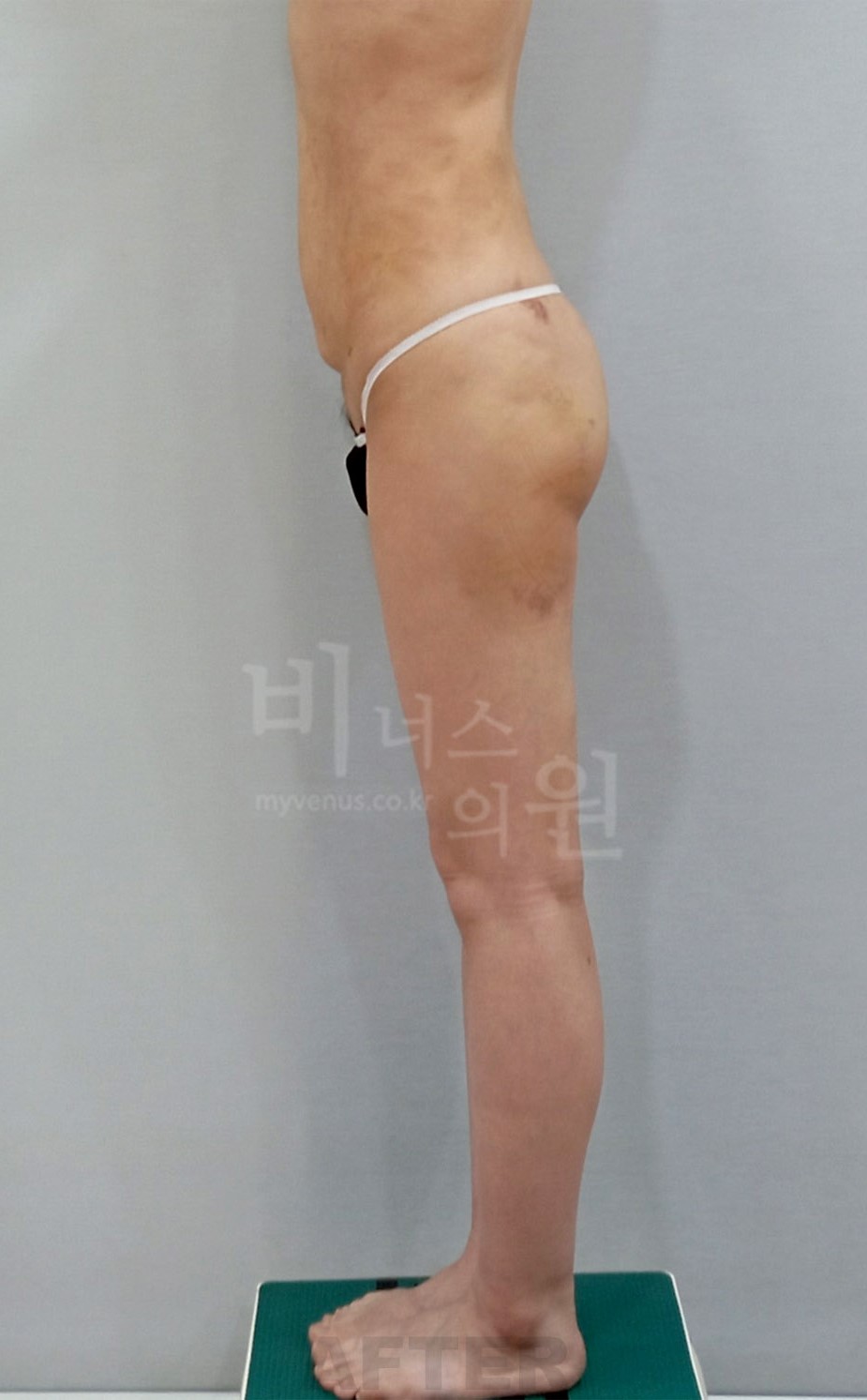 엉덩이처짐 지방흡입 측면 1 수술 후