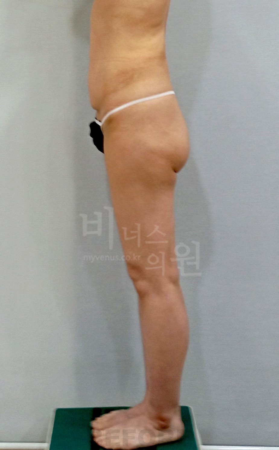 엉덩이처짐 지방흡입 측면 1 수술 전