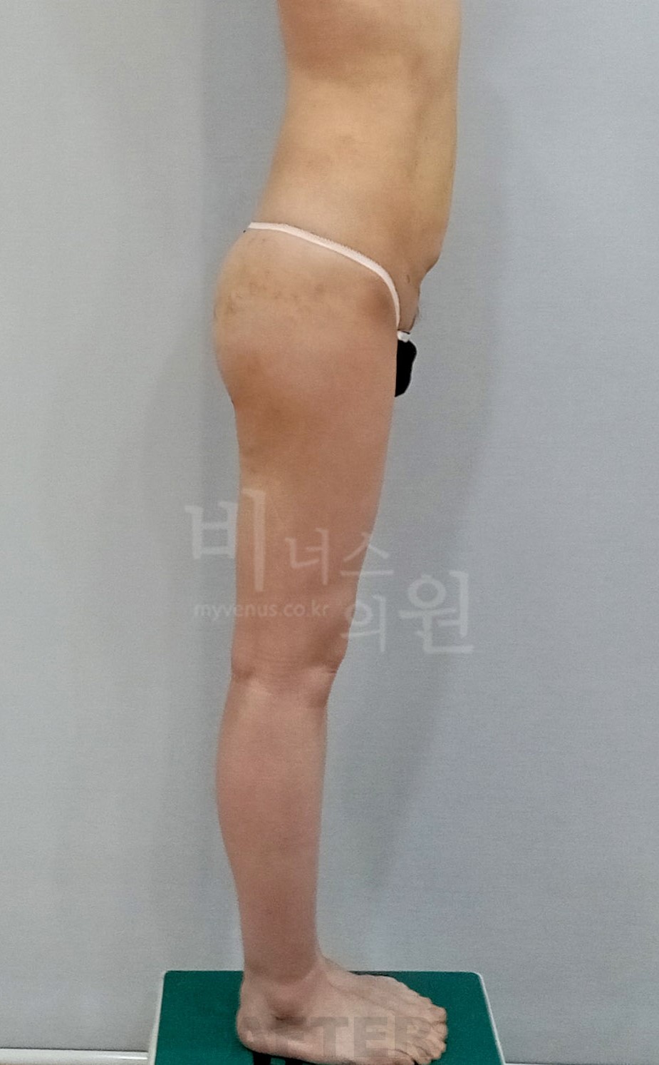 엉덩이처짐 지방흡입 측면 2 수술 후