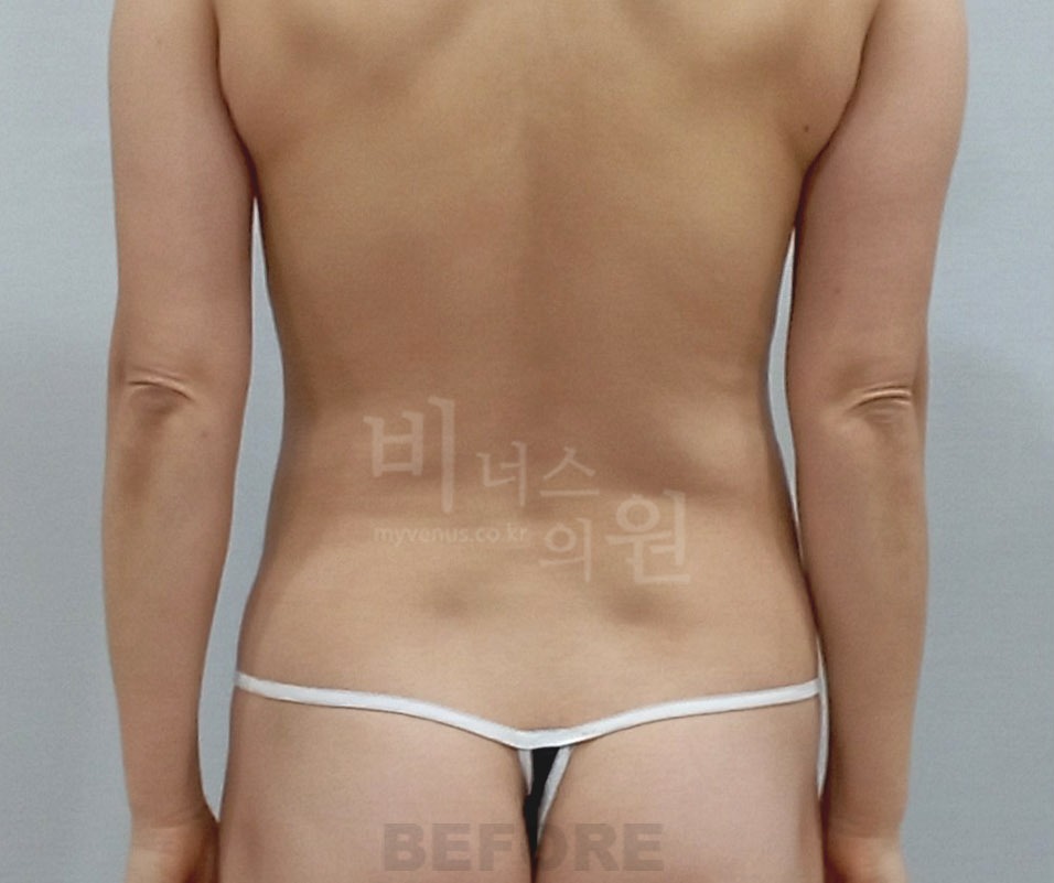 복부 지방흡입 수술 전 후면① 사진