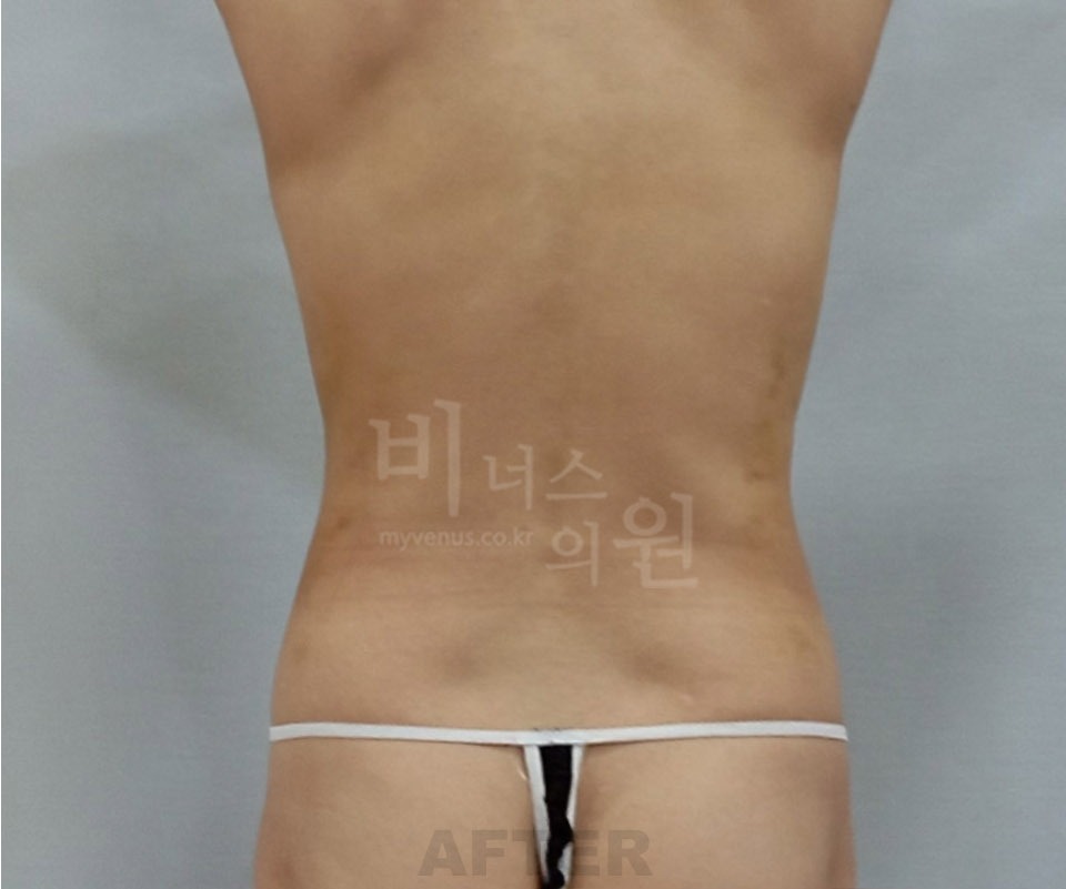 복부 지방흡입 수술 후 후면② 사진