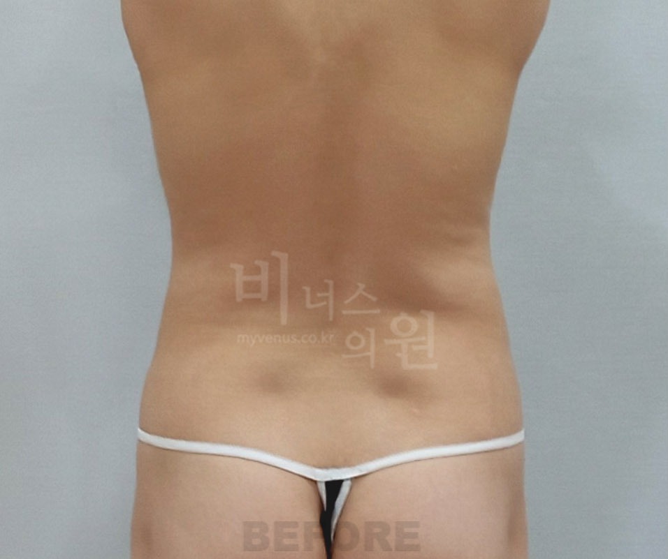 복부 지방흡입 수술 전 후면② 사진