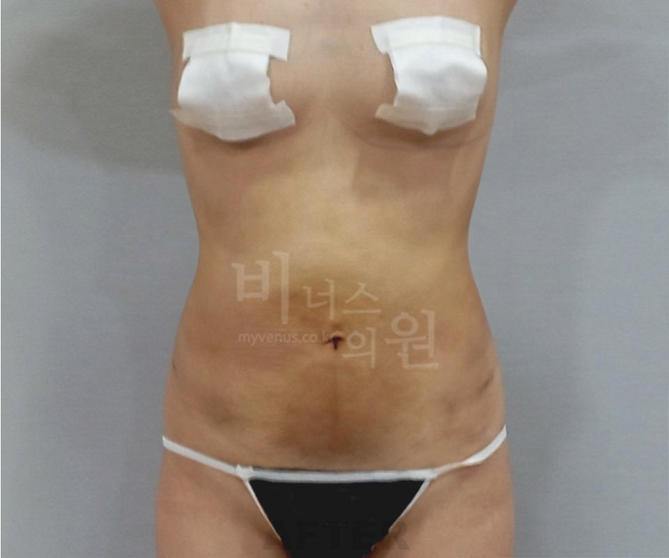 복부 지방흡입 수술 후 정면② 사진