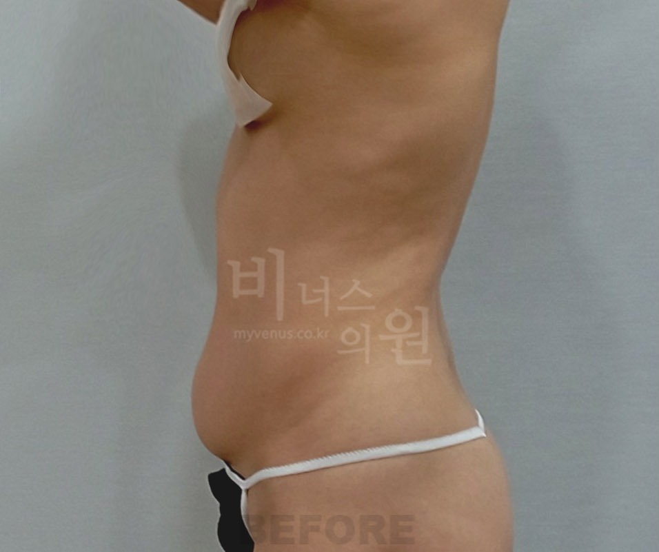 복부 지방흡입 수술 전 측면 사진