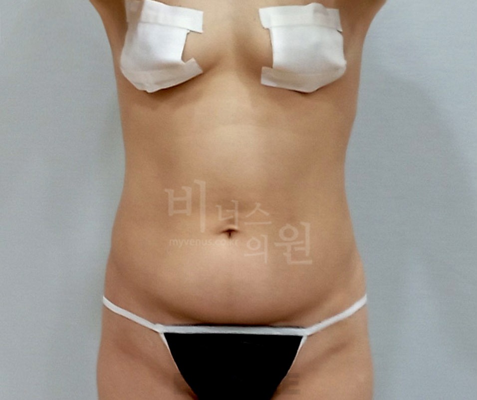 복부 지방흡입 수술 전 정면② 사진