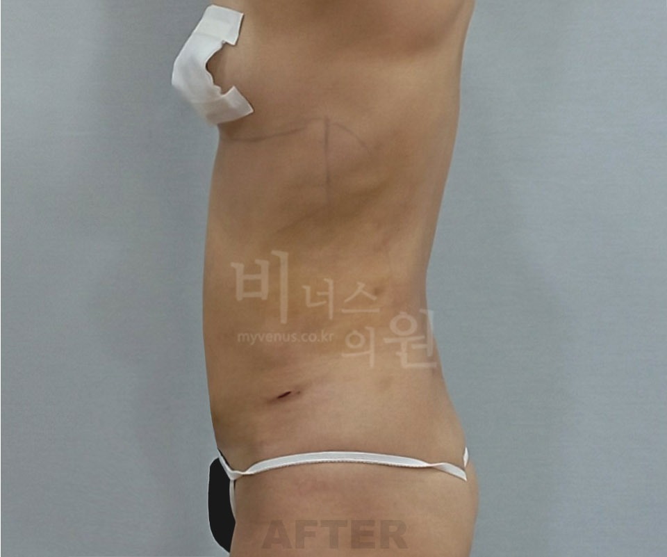 복부 지방흡입 수술 후 측면 사진