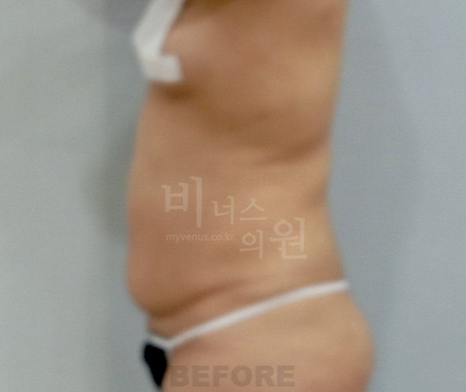 복부지방흡입 수술 전 측면