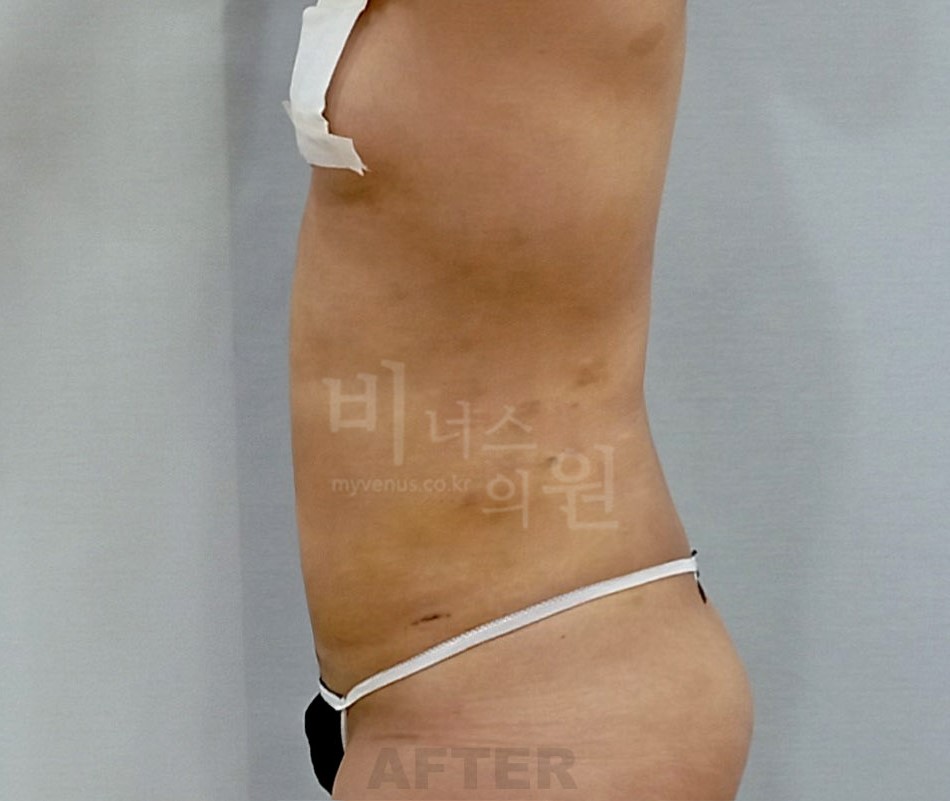 복부지방흡입 수술 후 측면