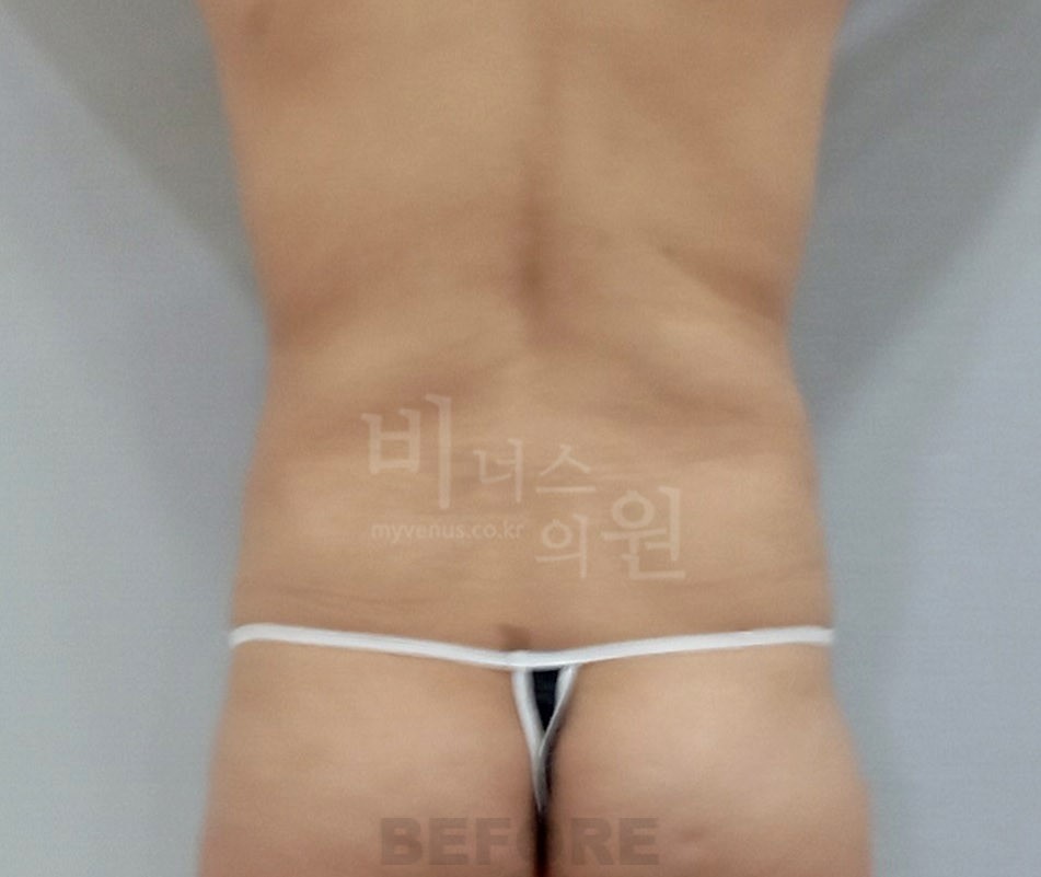 복부지방흡입 수술 전 후면