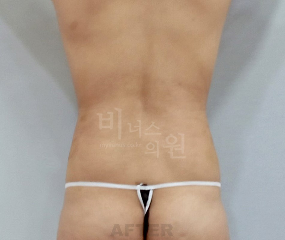 복부지방흡입 수술 후 후면